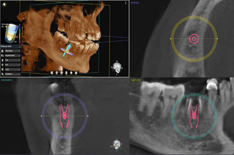 Phần mềm mô phỏng 3D phân tích dữ liệu từ phim CT Cone Beam, giúp chuyên gia lập kế hoạch cấy ghép implant chính xác và an toàn tuyệt đối.