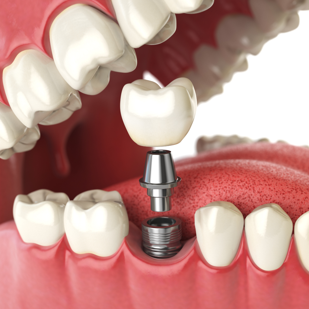 Mô hình 3D minh họa cấu tạo 3 phần của một răng cấy ghép implant, bao gồm trụ implant titanium, khớp nối abutment và mão răng sứ.