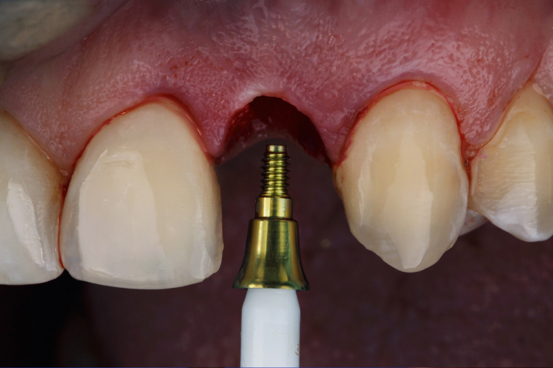 trụ lành thương abutment