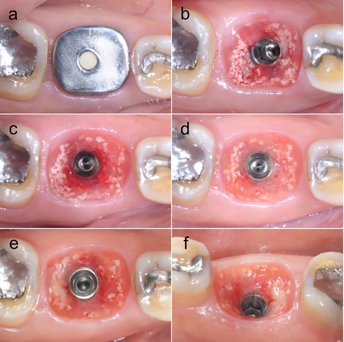 trụ lành thương healing abutment cá nhân hoá