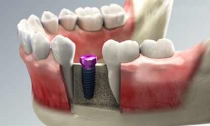 trụ lành thương healing abutment