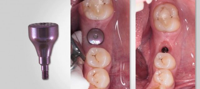trụ lành thương healing abutment chế tác sẵn