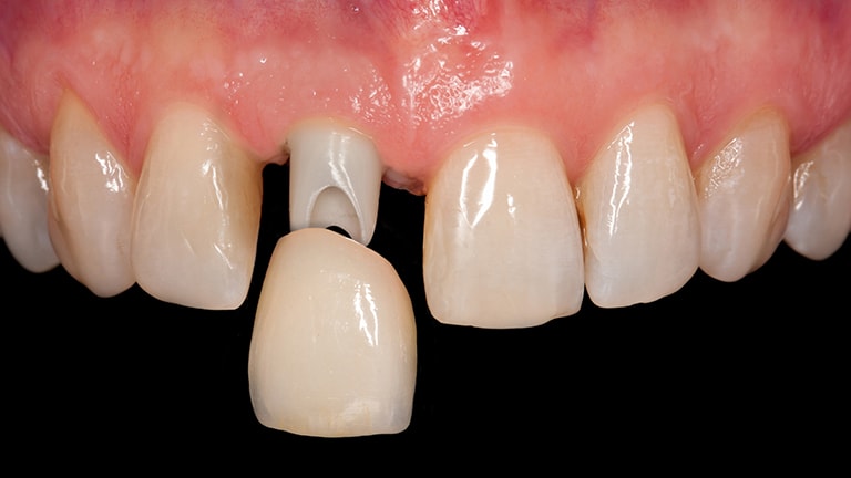 chụp răng toàn sứ lắp trên abutment sứ vùng răng cửa cho thẩm mỹ vượt trội