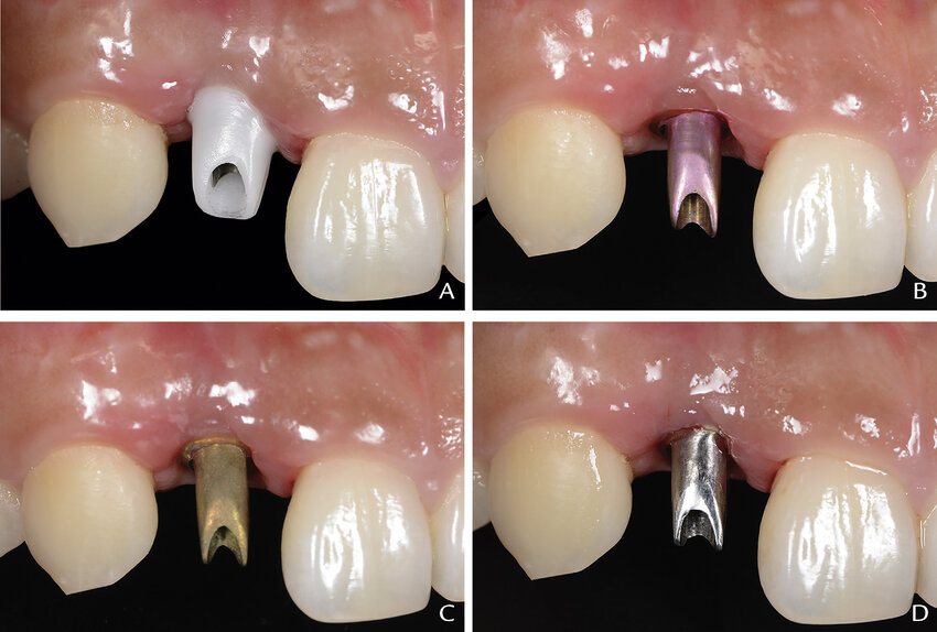 các loại abutment cho chụp sứ trên implant răng cửa
