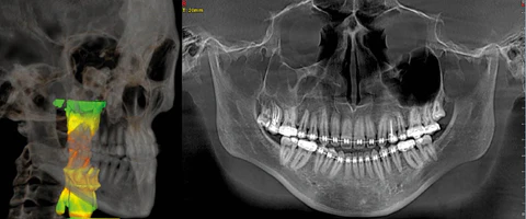 ct cone beam 3d vượt trội so vơi panorama 2d