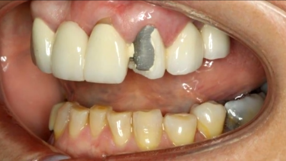 Răng kim loại cẩn sứ bị vỡ mẻ lộ cùi kim loại