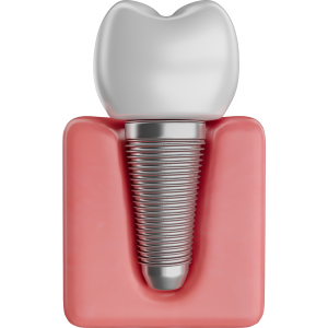cấy ghép implant nha khoa