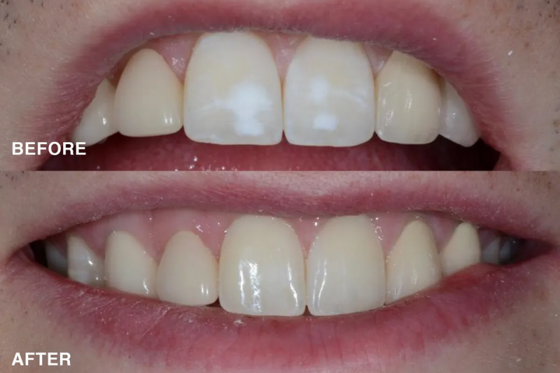 Kết quả điều trị tổn thương đốm trắng trên răng trước và sau