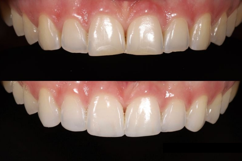 kết quả hàn răng thẩm mỹ răng cửa bằng resin composite trước và sau