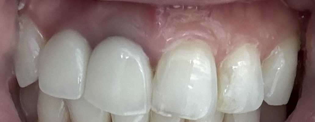 abutment kim loại titanium ánh màu kim loại qua lợi
