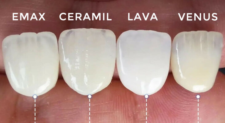 so sánh các loại răng sứ phổ biến
