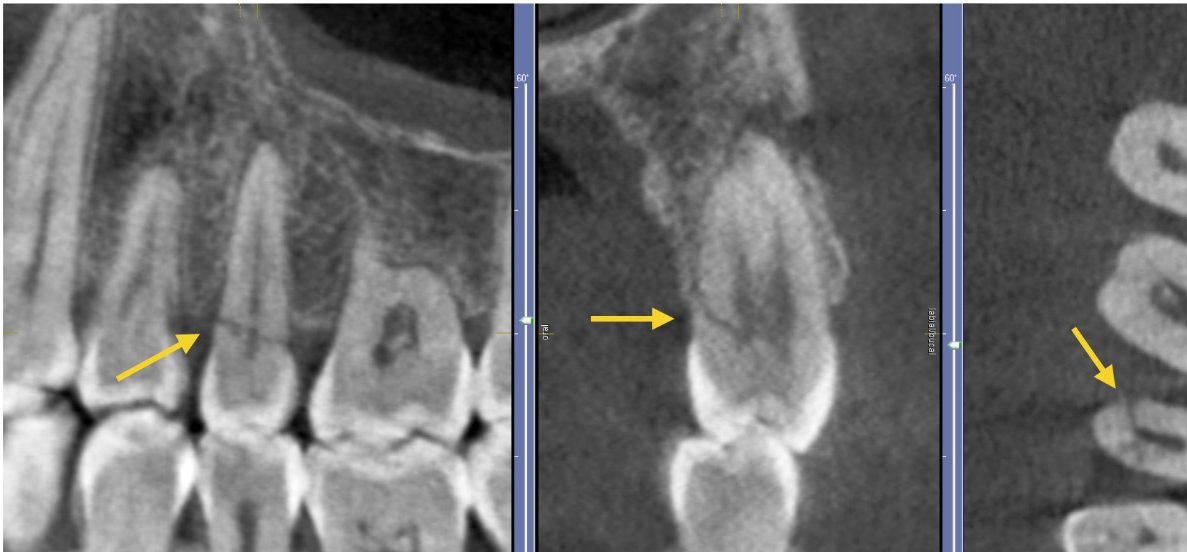 CT Cone Beam 3D trong nội nha giúp phát hiện các tổn thương phức tạp như ống tủy phụ hoặc nứt chân răng mà phim 2D có thể bỏ sót.