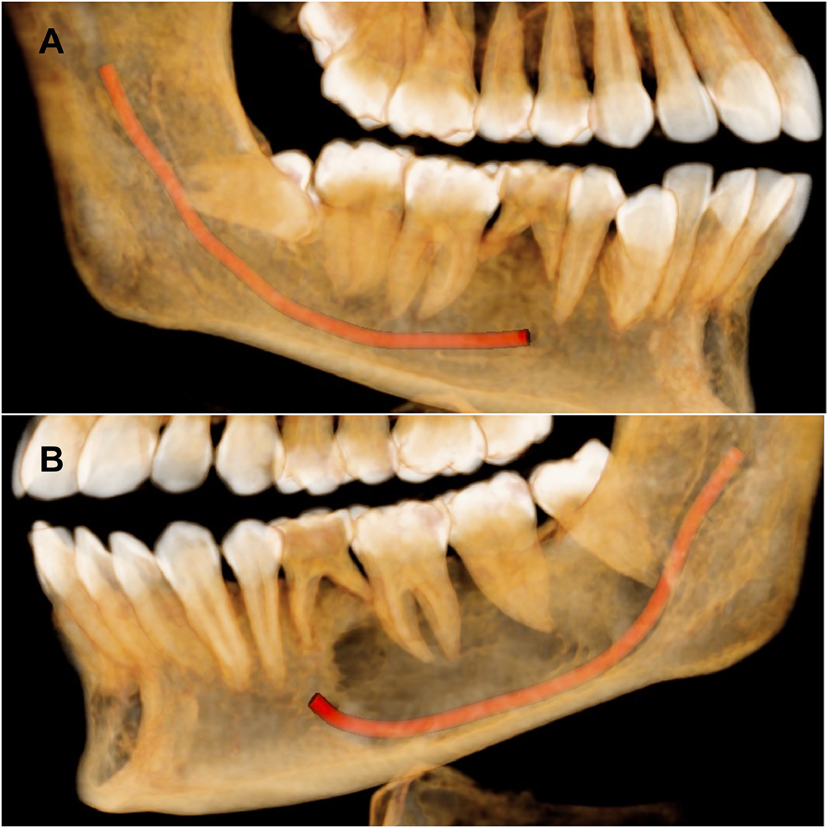 Hình ảnh CT Cone Beam 3D cho thấy vị trí dây thần kinh hàm dưới (đường màu đỏ) so với răng và vị trí cấy ghép implant, giúp bác sĩ phẫu thuật an toàn tuyệt đối.
