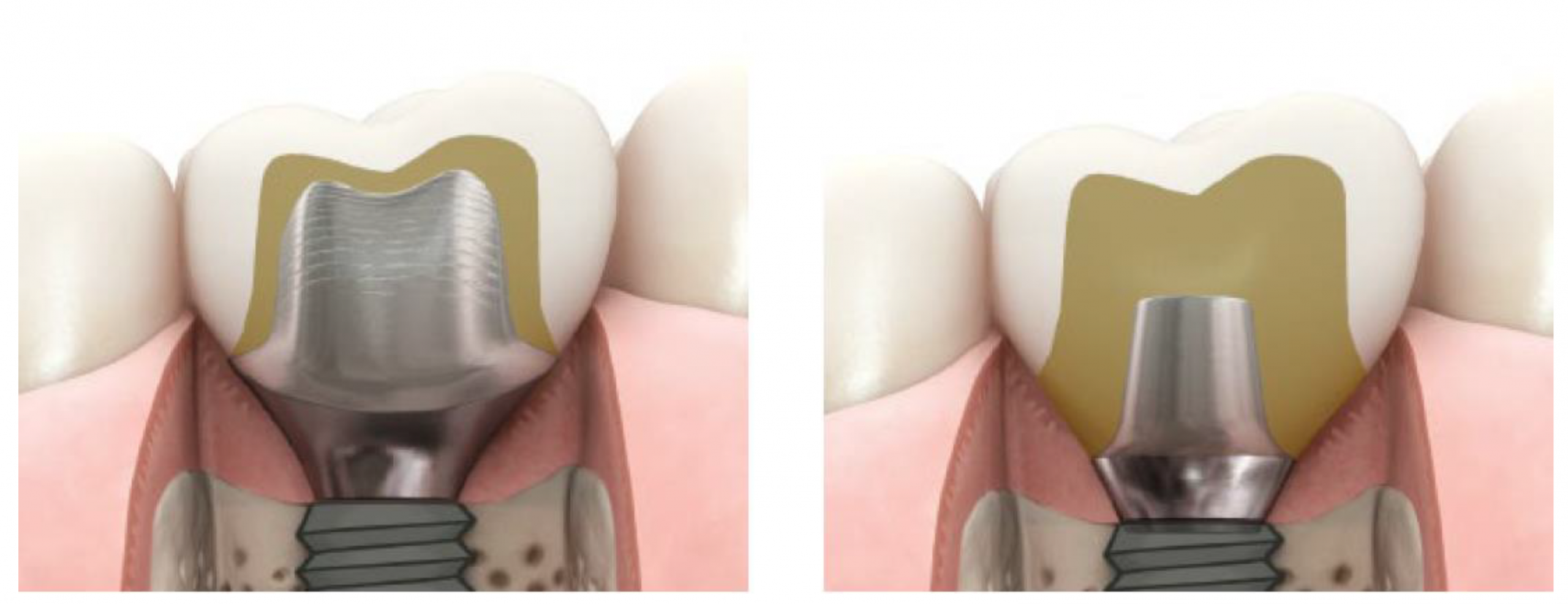 abutment cá nhân hoá vượt trội hơn kho so sánh với abutment chế tác sẵn khi lắp chụp sứ trên implant