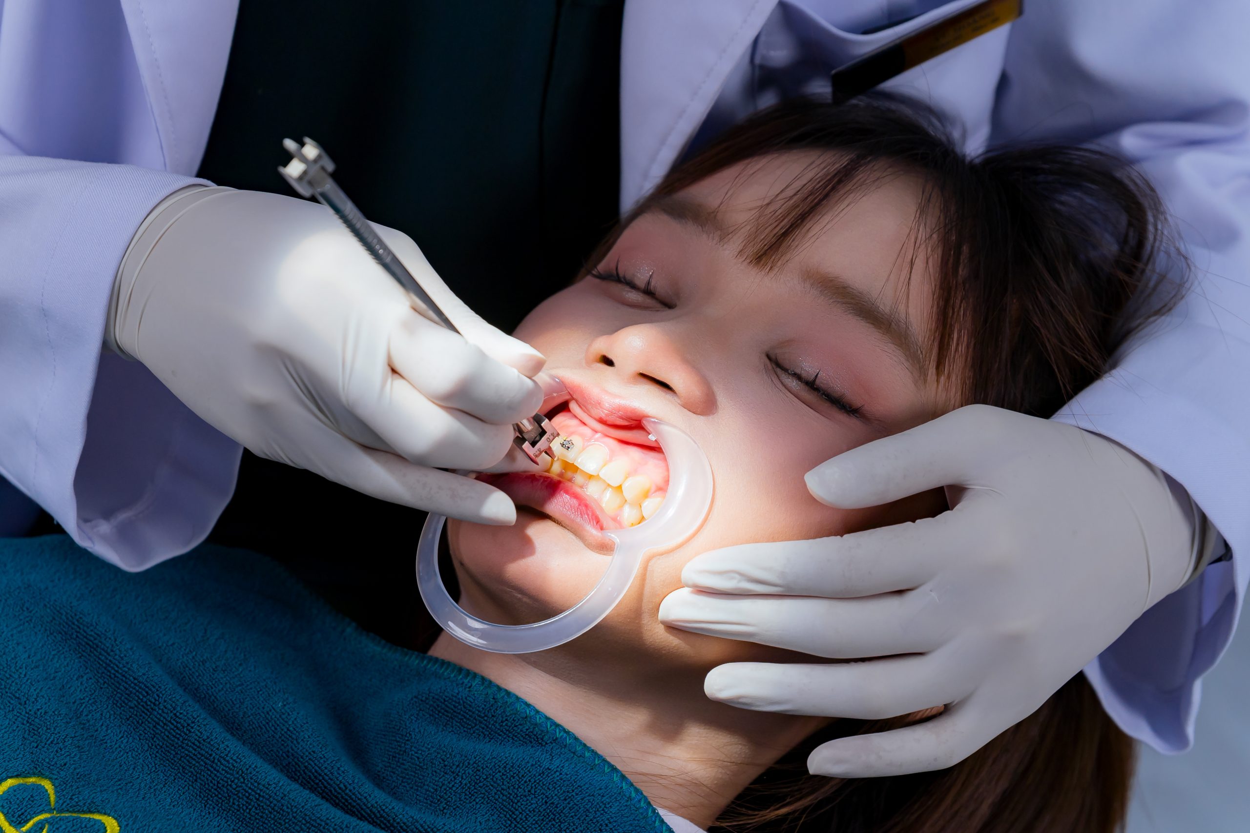 khách hàng gắn mắc cài niềng răng tại nha khoa ace smile, nha khoa uy tín tại hà đông