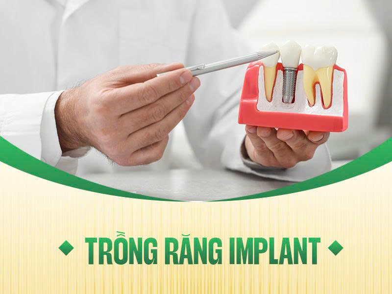 dịch vụ trồng răng implant tại nha khoa ace smile