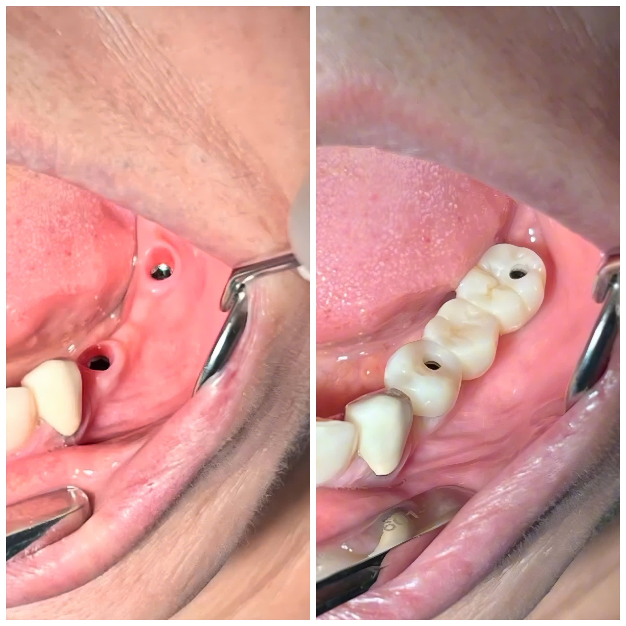 CẤY GHÉP IMPLANT CẦU IMPLANT RĂNG HÀM