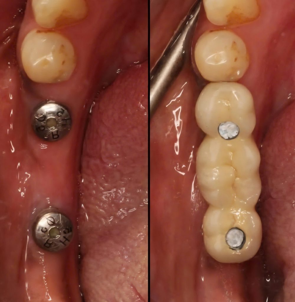 CẤY GHÉP IMPLANT CẦU RĂNG PHẦN RĂNG HÀM
