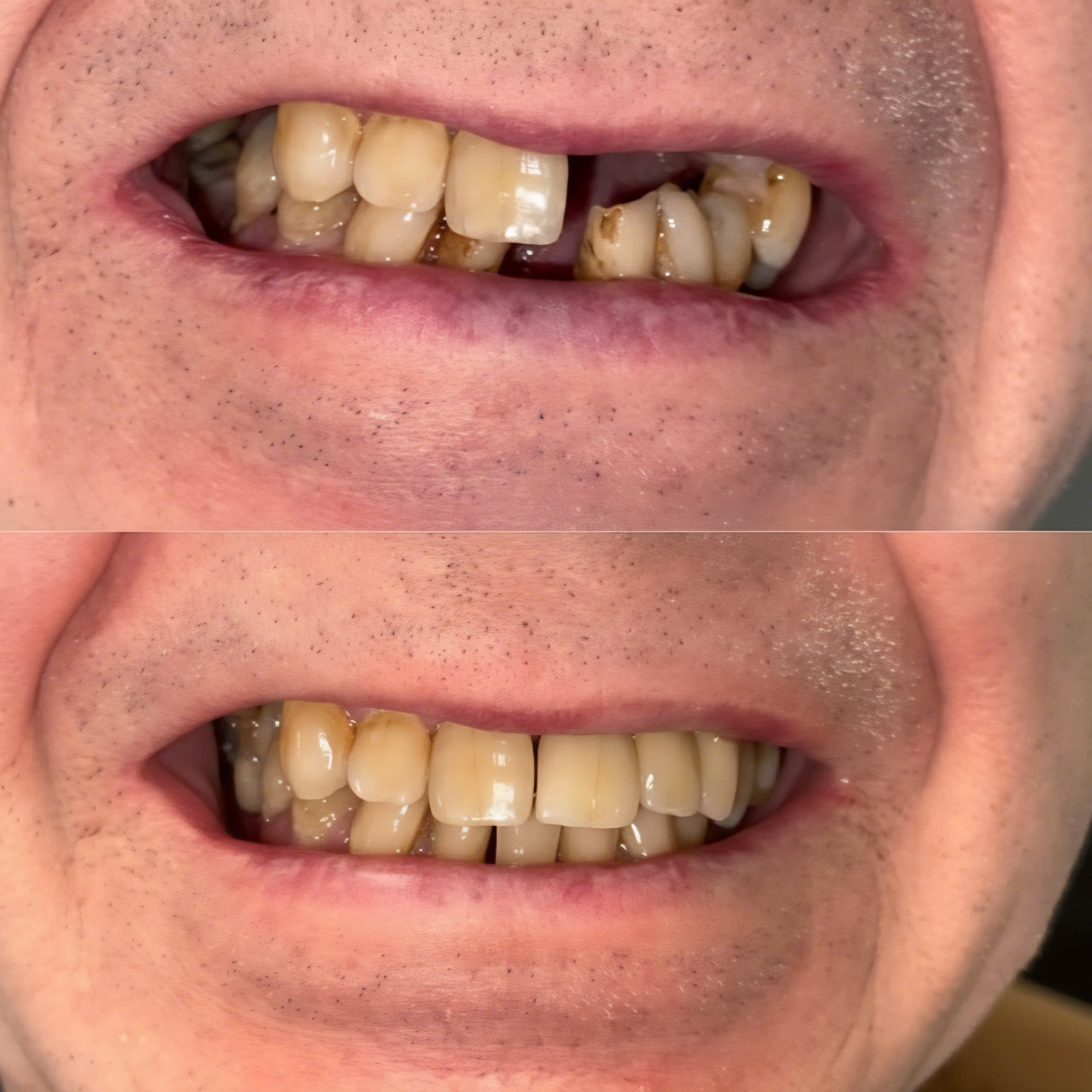 CẤY GHÉP IMPLANT CẦU RĂNG IMPLANT VÙNG RĂNG THẨM MỸ