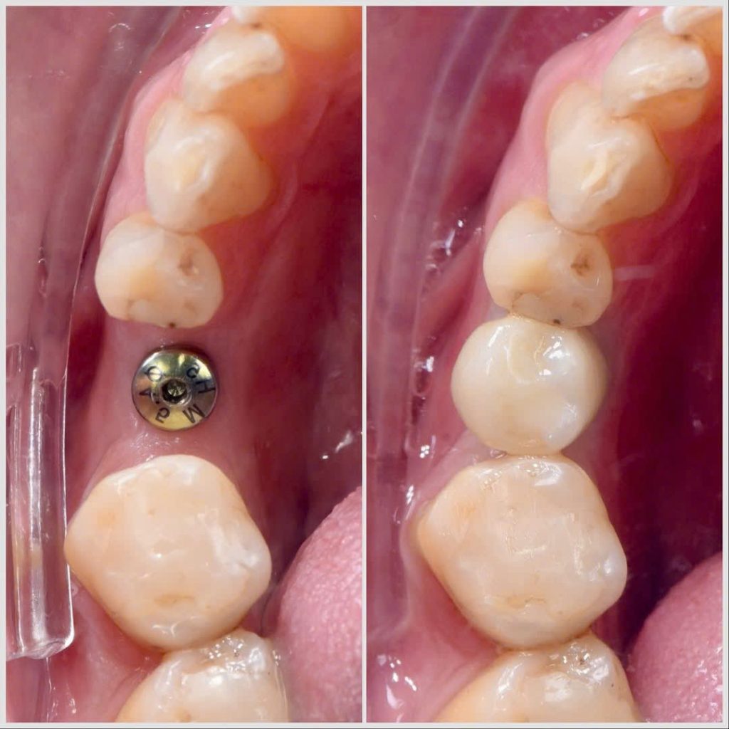 CA CẤY GHÉP IMPLANT MỘT RĂNG CỦA THẠC SĨ BÁC SĨ LẦU A MINH