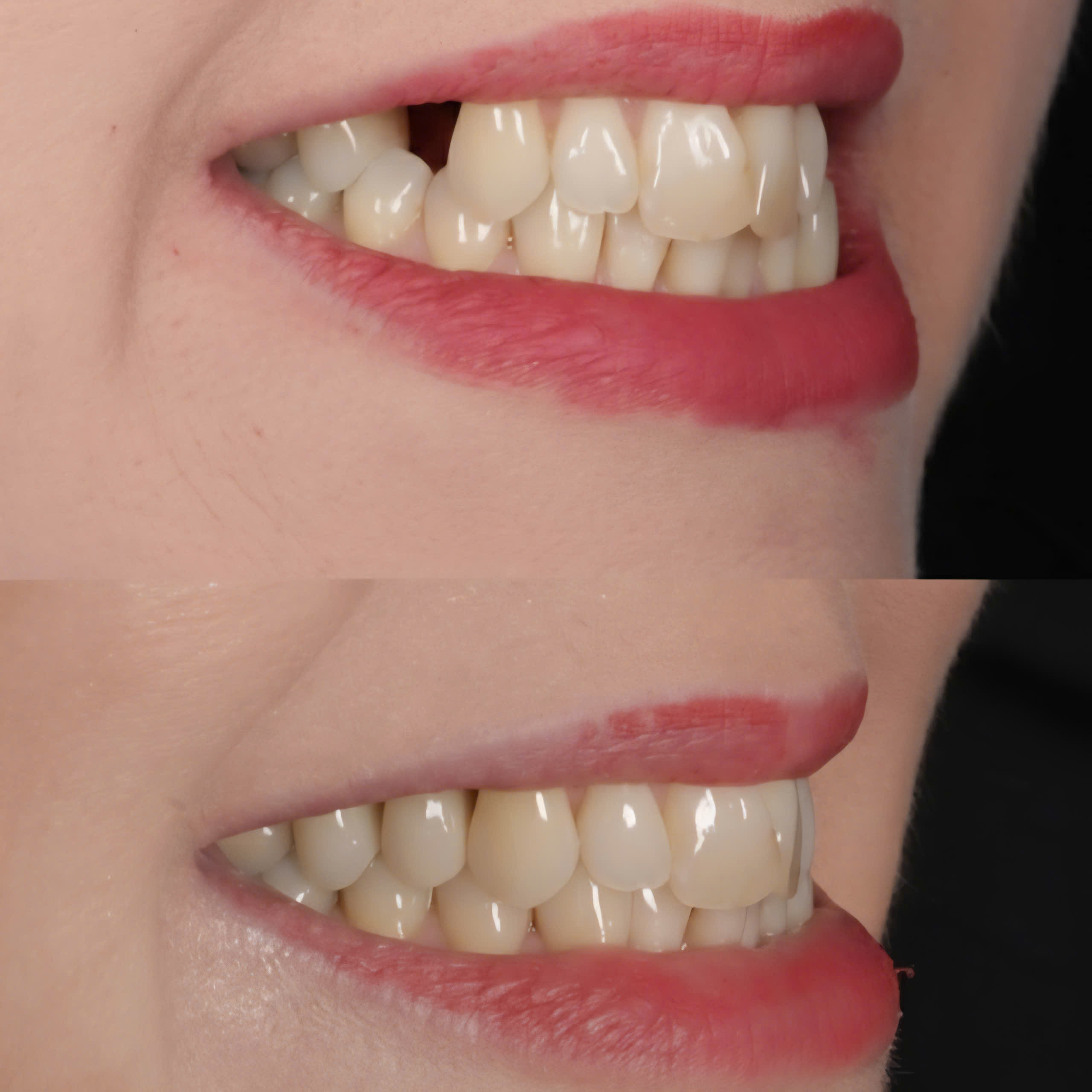 THẠC SĨ BÁC SĨ LẦU A MINH CẤY GHÉP IMPLANT MỘT RĂNG HÀM NHỎ THỨ NHẤT HÀM TRÊN