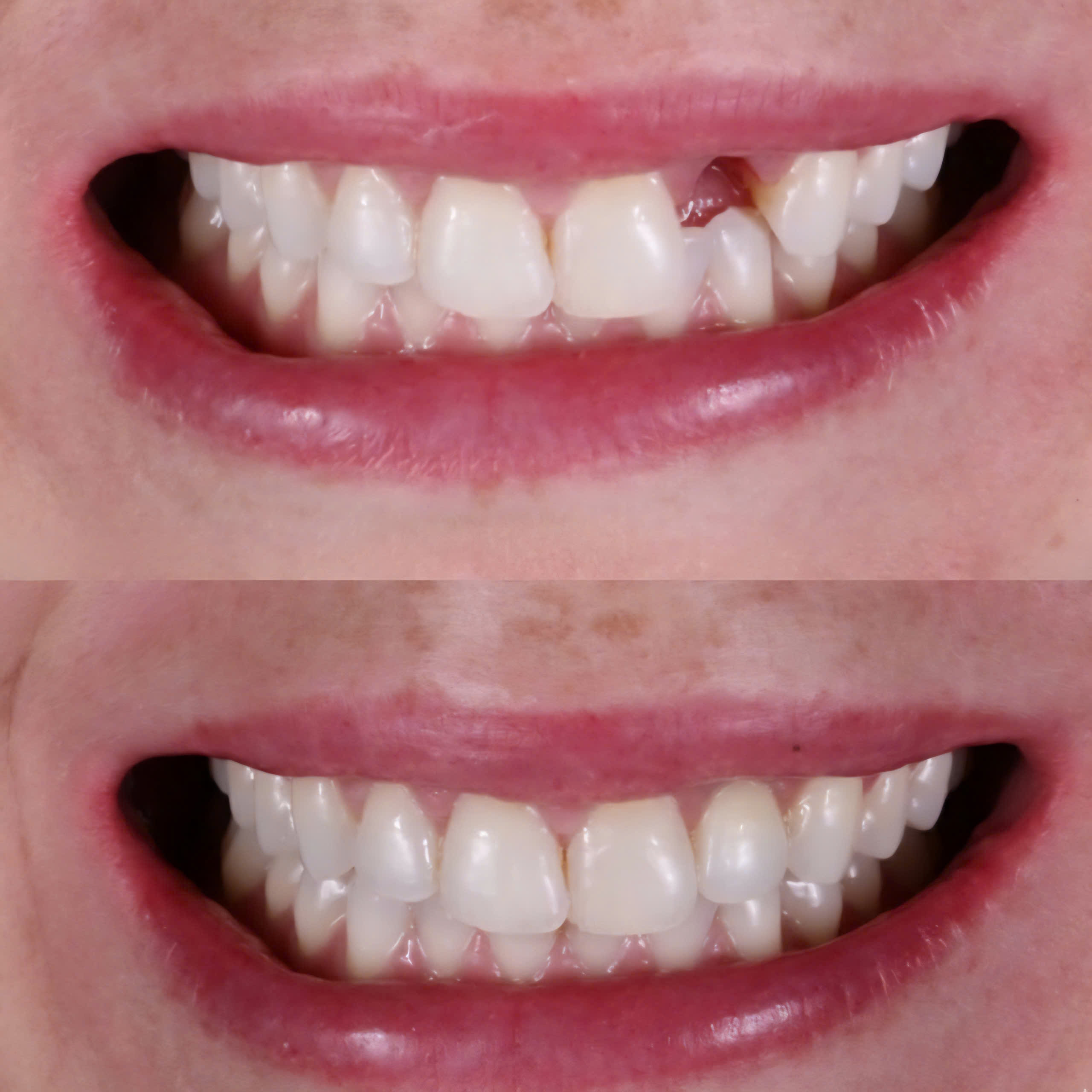 THẠC SĨ BÁC SĨ LẦU A MINH CẤY GHÉP IMPLANT MỘT RĂNG VÙNG THẨM MỸ RĂNG CỬA