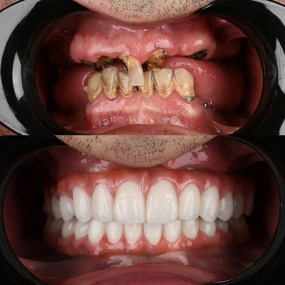 CẤY GHÉP IMPLANT TOÀN HÀM CÒN MỘT VÀI RĂNG