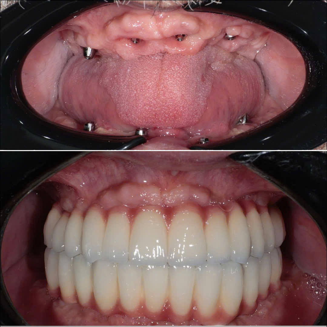 CẤY GHÉP IMPLANT TOÀN HÀM MẤT TOÀN BỘ RĂNG HAI HÀM