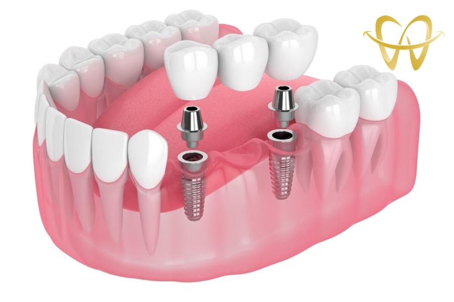 Chuyên Gia Giải Đáp: Thời Gian Trồng Răng Implant Bao Lâu