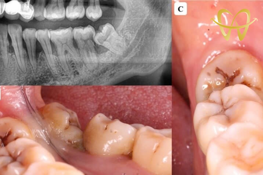 Nhận Biết Sớm 5 Dấu Hiệu Răng Khôn Mọc Lệch