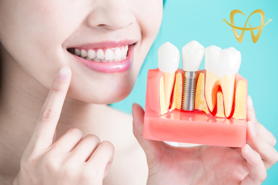 Những Lưu Ý Khi Trồng Răng Implant Bác Sĩ Luôn Dặn Bạn