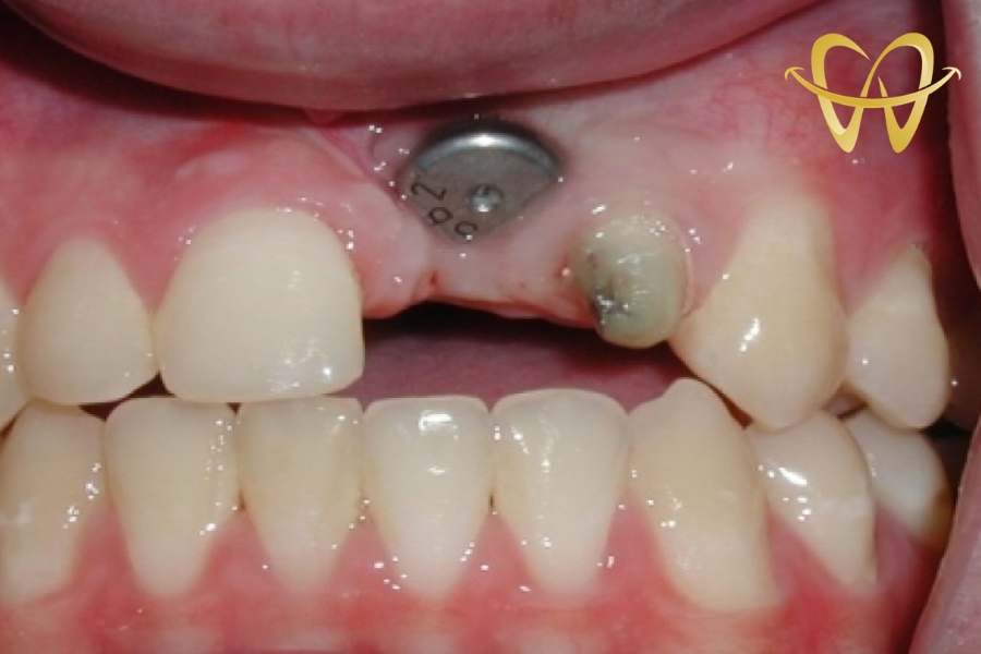 Trồng Implant Răng Cửa - Giải Pháp Hoàn Hảo Lấy Lại Nụ Cười Tự Nhiên