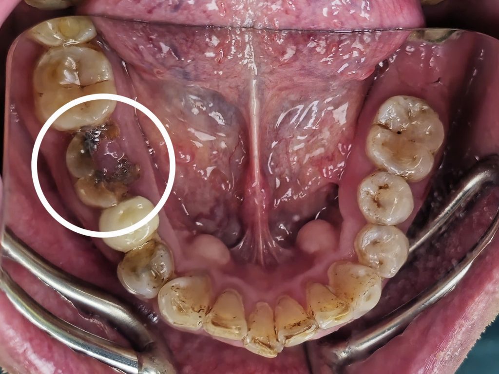 răng sâu vỡ lớn