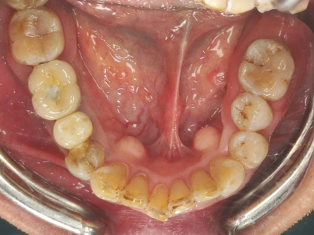 sau cấy ghép implant