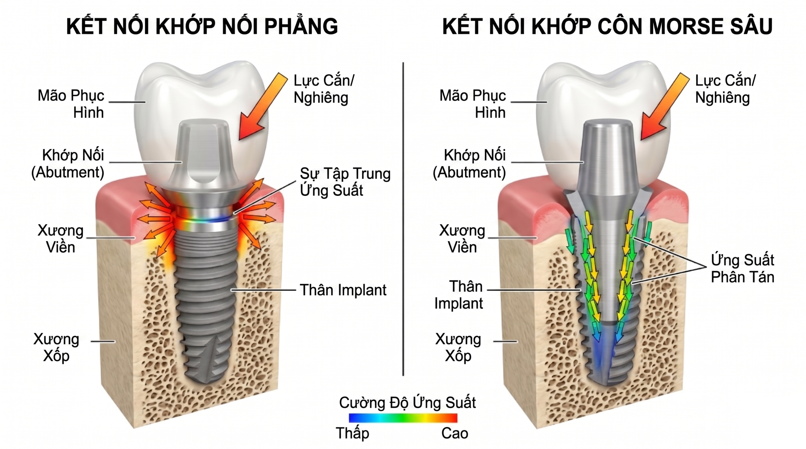 thiết kế khớp nối của implant giúp phân tán lực - minh họa thoe tư vấn của thạc sĩ bác sĩ Lầu A Minh