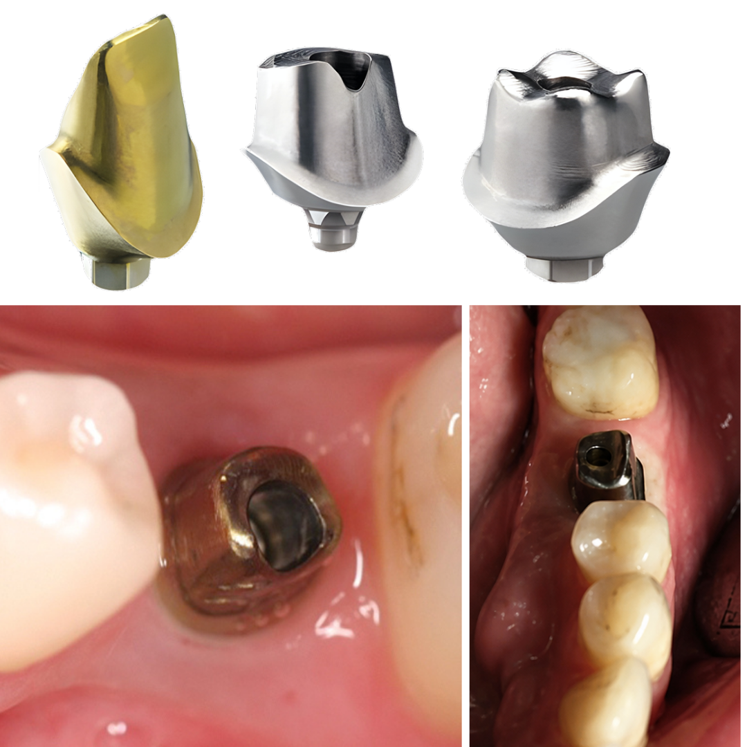 trụ phục hình cá nhân hóa