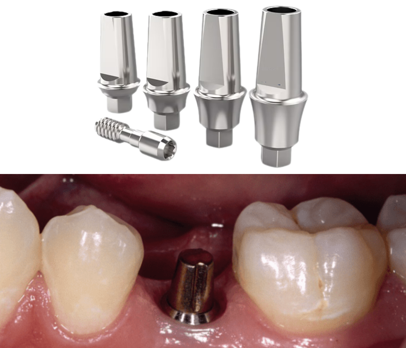 trụ phục hình theo hãng (stock abutment)